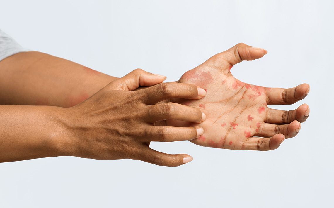 Image of a women's hands with atopic dermatitis